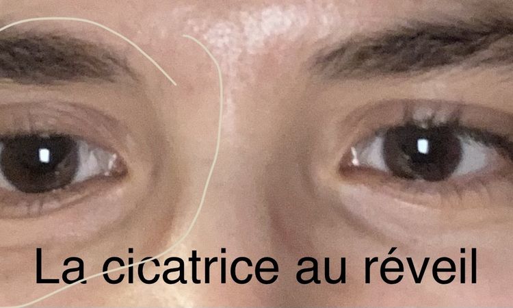 Œdème lymphatique suite brûlure au retinal contour de l’œil : que faire ? - 58484