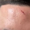 Cicatrice sur le front : le meilleur traitement ?