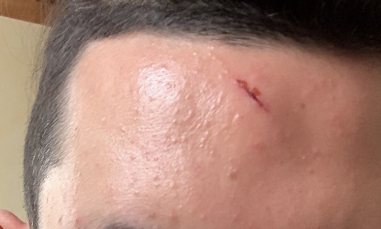 Cicatrice sur le front : le meilleur traitement ? - 59294