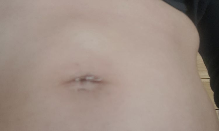Boule dure au-dessus du nombril après liposuccion - 59459