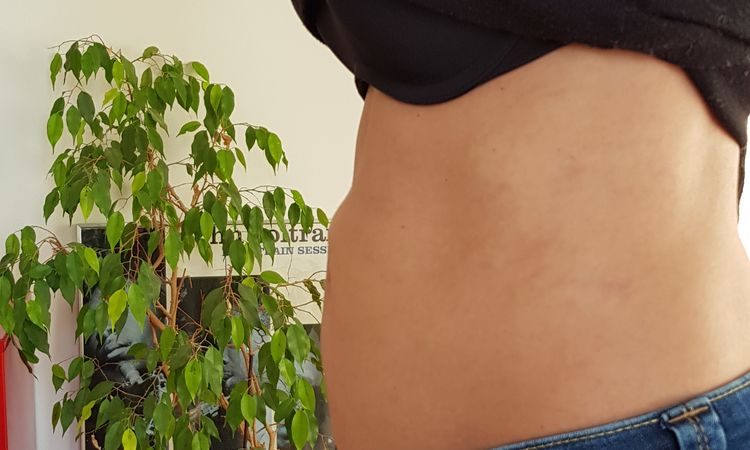 Boule dure au-dessus du nombril après liposuccion - 59460