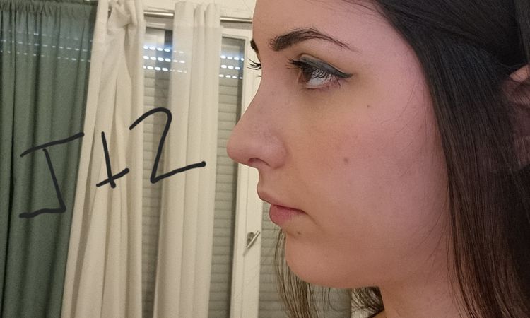 Projection nez après rhinoplastie - 60277