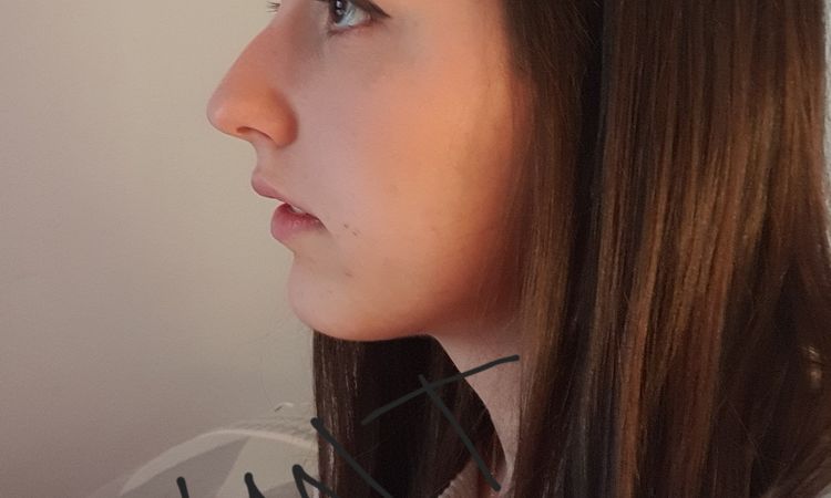 Projection nez après rhinoplastie - 60279