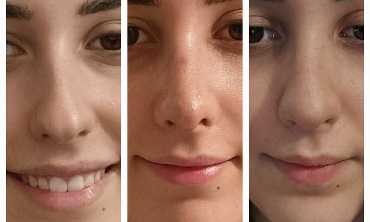 Boule sur la pointe après rhinoplastie - 60511