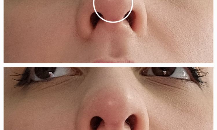 Boule sur la pointe après rhinoplastie - 60512