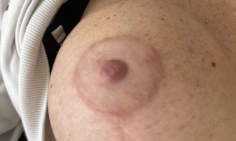 Un sein plus gros et plus dur après lifting et augmentation mammaire - 61800