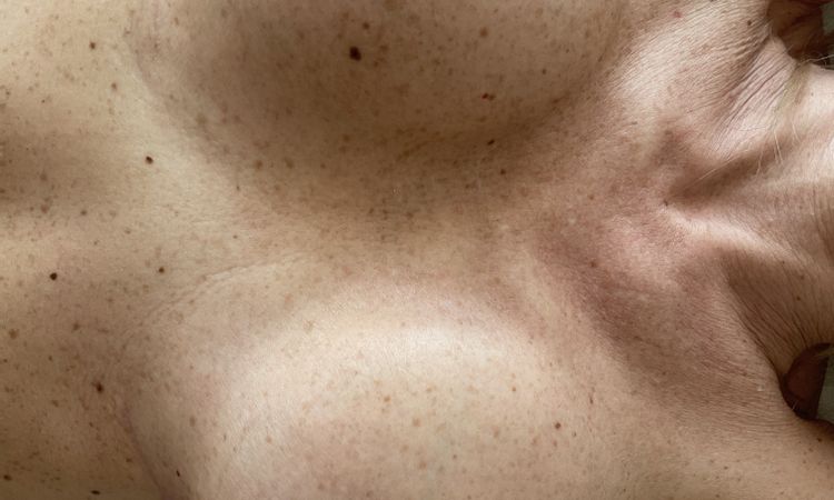 Un sein plus gros et plus dur après lifting et augmentation mammaire - 61801