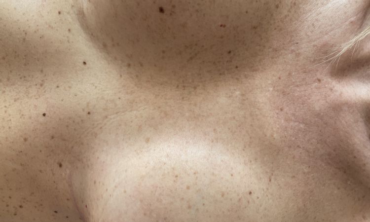 Un sein plus gros et plus dur après lifting et augmentation mammaire - 61803