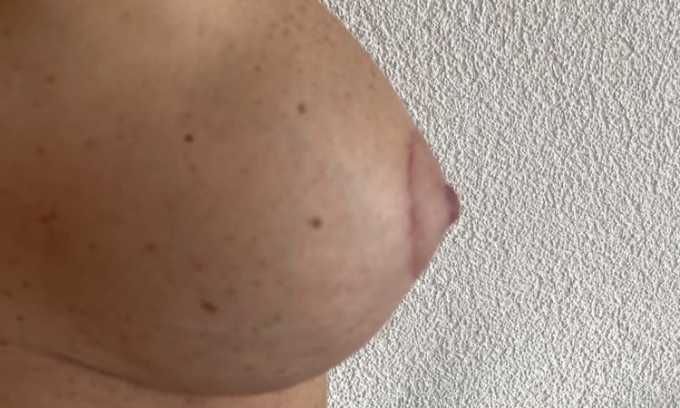 Un sein plus gros et plus dur après lifting et augmentation mammaire - 61806