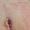 Cicatrice après pose d'implants fessiers