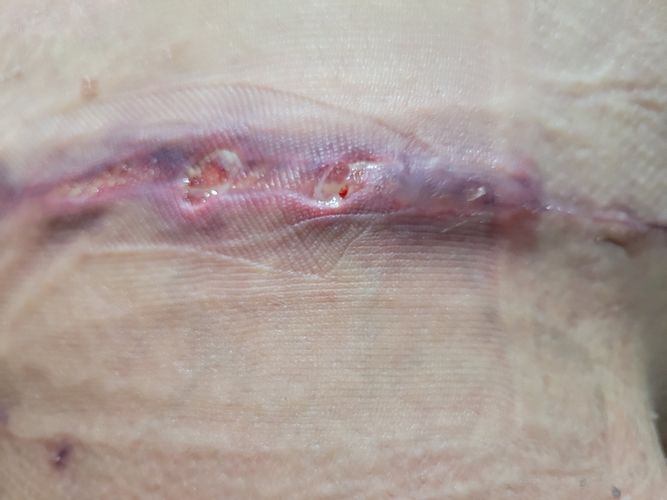 Bodylift et retard de cicatrisation