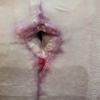 Bodylift et retard de cicatrisation