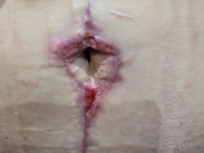 Bodylift et retard de cicatrisation