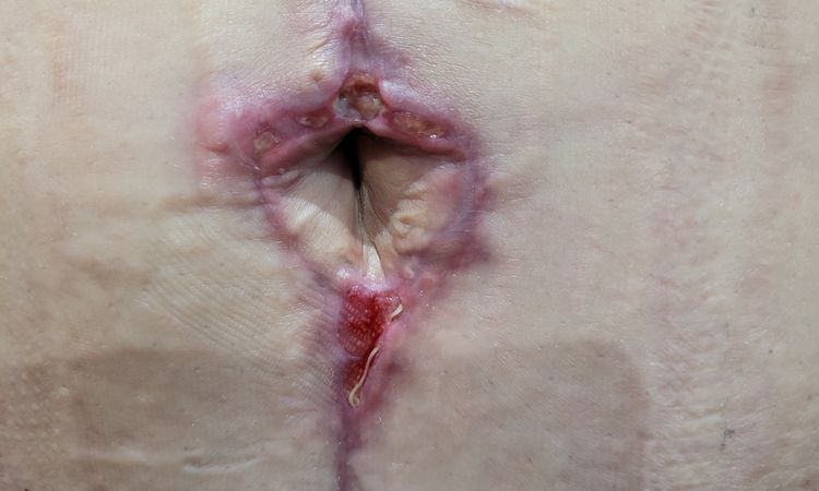 Bodylift et retard de cicatrisation - 61990