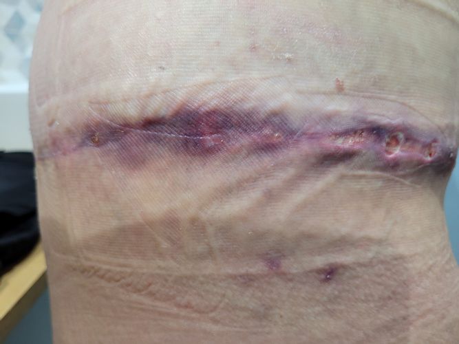 Bodylift et retard de cicatrisation