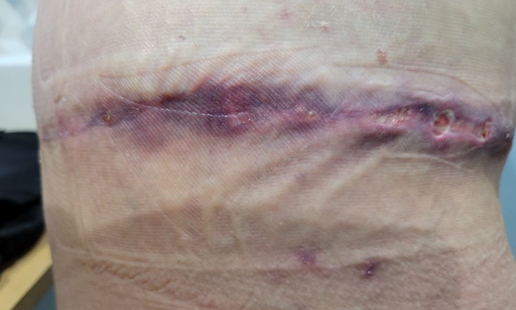 Bodylift et retard de cicatrisation - 61991