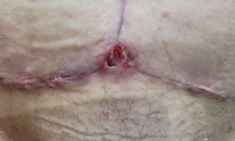 Bodylift et retard de cicatrisation - 61992