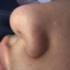 Formation d’une boule sur le nez
