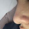 Formation d’une boule sur le nez