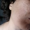 Traitement pour les cicatrices d'acnée