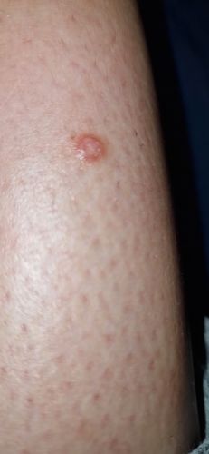 Avis sur un bouton qui gratte