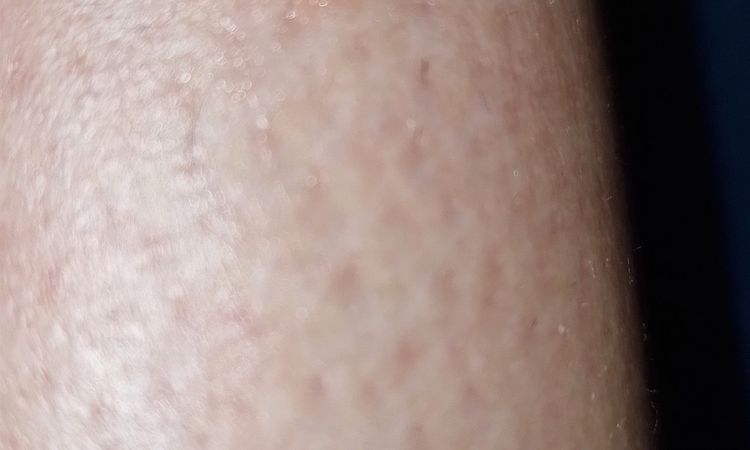 Avis sur un bouton qui gratte - 64242