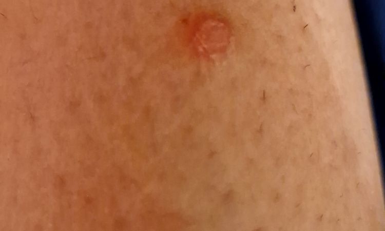 Avis sur un bouton qui gratte - 64243