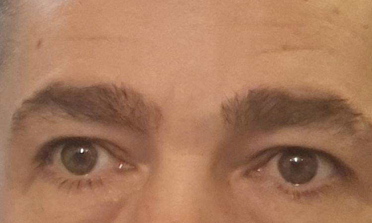 Blépharoplastie inferieure : poches ou œdèmes ? - 64547