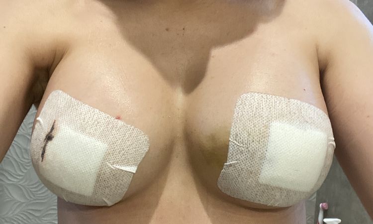 Asymétrie suite à augmentation mammaire - 65347
