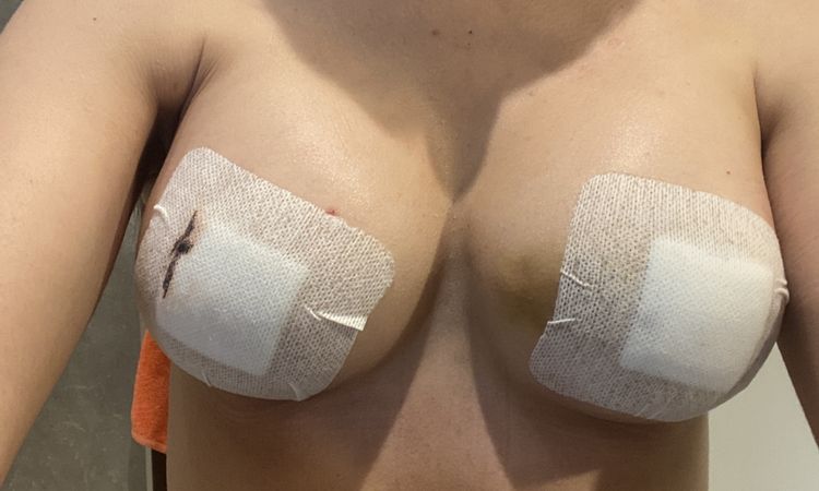 Asymétrie suite à augmentation mammaire - 65348