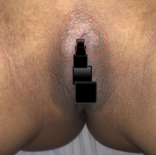 Depigmentation partie intime
