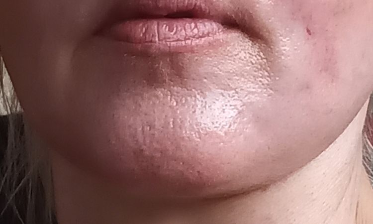 Irritations post peeling - 65524