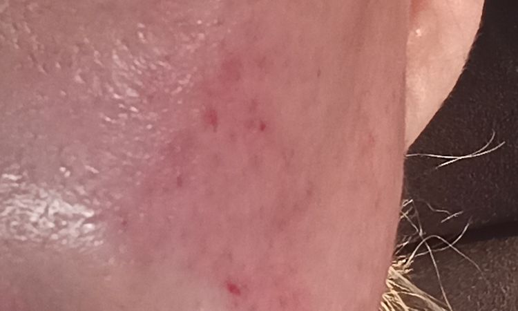 Irritations post peeling - 65525