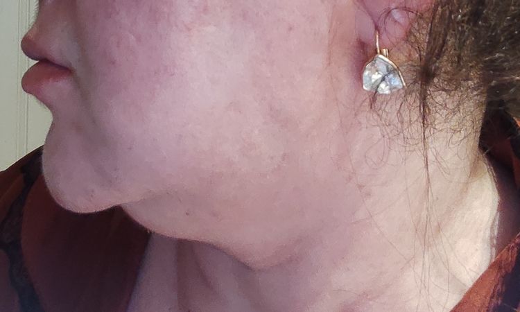 Tarifs lipoaspiration double menton - 65710