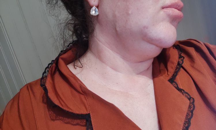 Tarifs lipoaspiration double menton - 65713