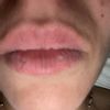 2 cicatrices sur ma lèvres supérieure dues aux boutons d’herpès