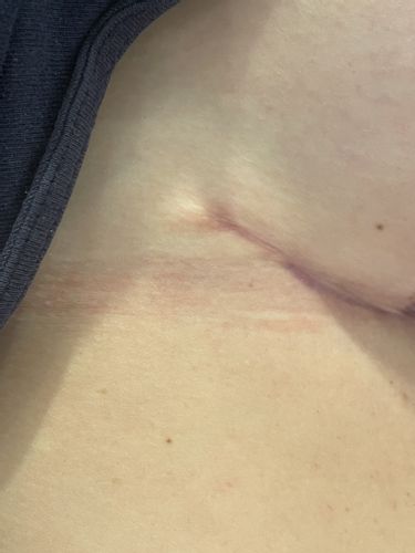 Aspect des cicatrices 3 mois après ptose mammaire
