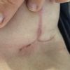 Aspect des cicatrices 3 mois après ptose mammaire