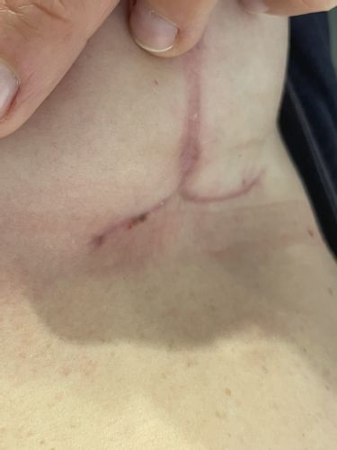 Aspect des cicatrices 3 mois après ptose mammaire