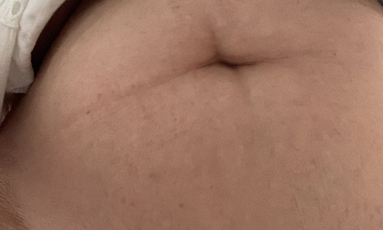 Abdominoplastie à 65 ans - 66895