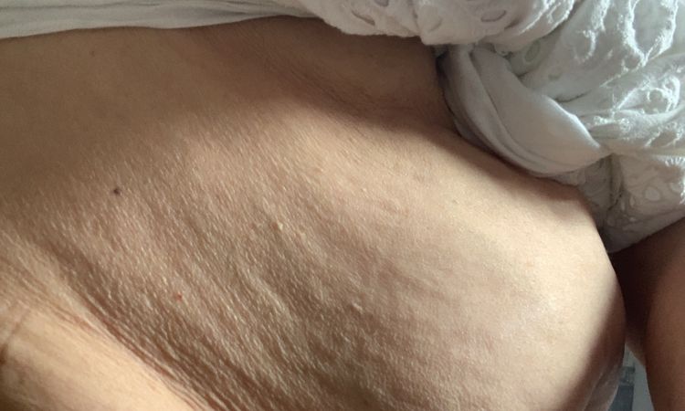 Abdominoplastie à 65 ans - 66896