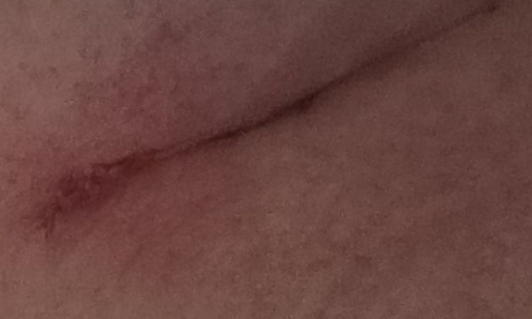 sensation de brûlure mamelons après mastopexie - 67244