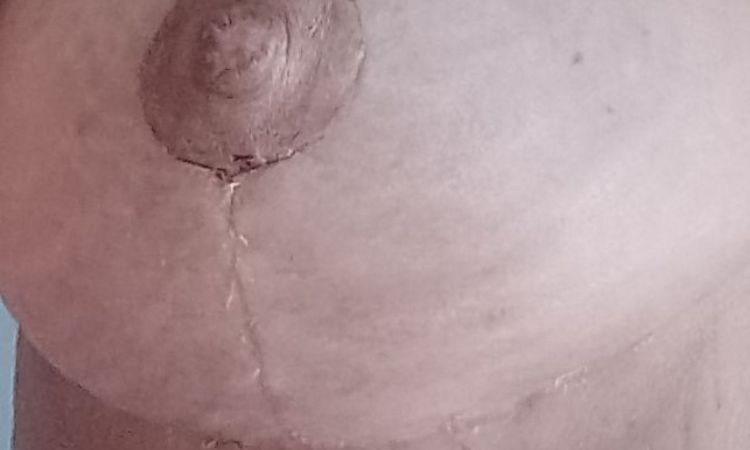 sensation de brûlure mamelons après mastopexie - 67245