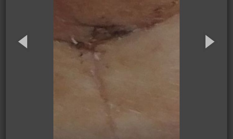 sensation de brûlure mamelons après mastopexie - 67247