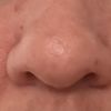 Correction de la pointe et des narines par rhinoplastie médicale - 67720