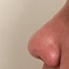 Correction de la pointe et des narines par rhinoplastie médicale - 67721
