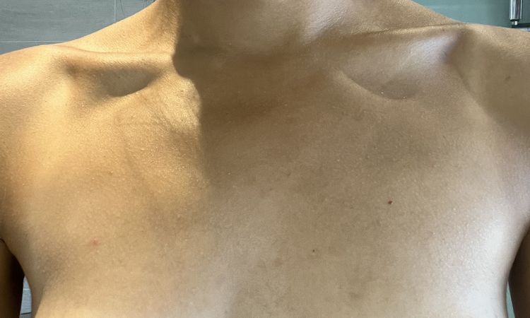Questions sur les seins tubéreux - 67995