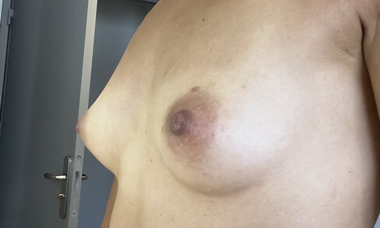 Questions sur les seins tubéreux - 67997