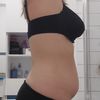 Diastasis et renforcement musculaire
