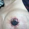 Réduction mammaire à J16
